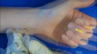 Hand Injection Techniques  Carpal Tunnel Syndrome [upl. by Jase]