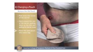 ColostomyIleostomy Changing a Pouch [upl. by Azer]