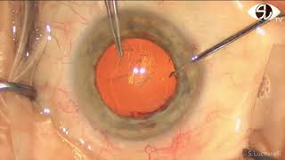 Simple method to achieve mechanical pupil dilatation in Small pupil cataract surgery ENG [upl. by Suter934]