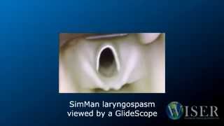 Programming Awake Laryngospasm [upl. by Natsud]