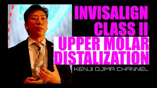 Invisalign Class II Upper Molar Distalization【インビザライン大臼歯遠心移動】 [upl. by Anemaj467]