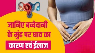 बच्चेदानी के मुंह पर घाव का कारण एवं ईलाज  Uterus Ulcer Symptoms in Hindi  Dr Sushila Saini [upl. by Llenwahs]