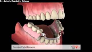 Prosthodontics  Precision Partial Denture  Ottawa Dentist [upl. by Eelsha]