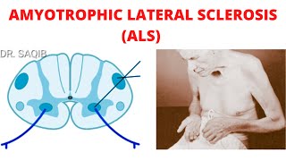 Amyotrophic Lateral Sclerosis ALS [upl. by Balliett]