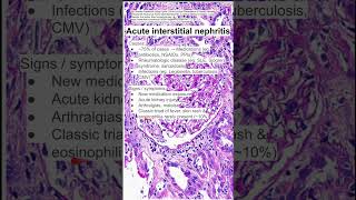 Acute interstitial nephritis [upl. by Yerffeg]