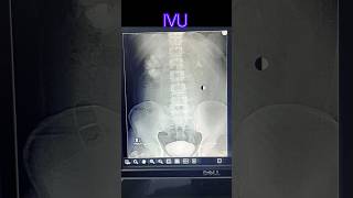 Intra venous urogram  pyelogram  radiological xray medicalimaging doctor anatomy [upl. by Ticon]