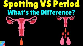 What is the difference between Spotting and Period – Spotting VS Period [upl. by Hoxsie683]