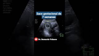 SACO GESTACIONAL DE 7 SEMANAS DE GESTACIÓN [upl. by Ainotna]