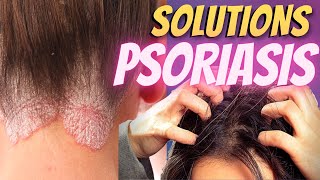 CROÛTES PLAQUES  La peau fait nimporte quoi  Psoriasis  Panacée 14 [upl. by Solange]