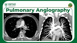 Pulmonary Angiography Indications Techniques amp Results What Is Pulmonary Angiography Used For [upl. by Tewfik]