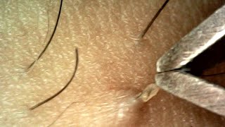 Pulling Hair and Blackheads with Tweezers [upl. by Haras]