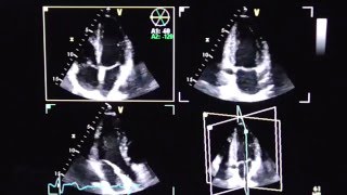 Triplane Echokardiographie triplane echocardiography [upl. by Shaffert]