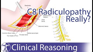 Ulnar Nerve Entrapment mimicking C8 Radiculopathy [upl. by Yorgos]