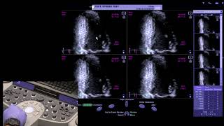 Piedmont Healthcare Stress Echo Protocol on Siemens SC2000 [upl. by Newell]