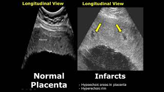 Placenta Ultrasound Normal Vs Abnormal Image Appearances Comparison  Placental Pathologies on USG [upl. by Oigaib]