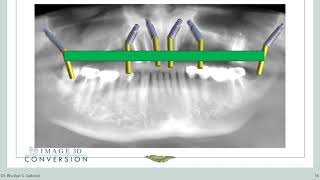 Season 1 Ep 3  Mastering Pterygoid implants and digital planning A comprehensive exploration [upl. by Kalman]