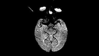 Normal brain perfusion [upl. by Louise]