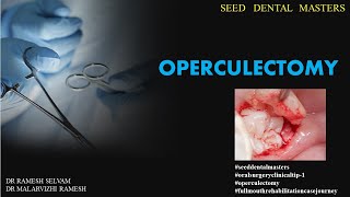 SEED DENTAL MASTERS  OPERCULECTOMY [upl. by Kempe]