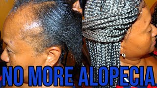 The BEST Way To Install l ALOPECIA Crochet Box Braids Hairstyles l [upl. by Jud960]