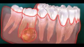 Abcès endodontique dentaire kyste [upl. by Cheri207]