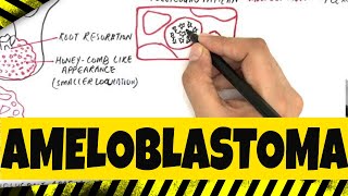 Ameloblastoma  Origination Clinical Radiographic amp Histopathologic features [upl. by Nnoj540]