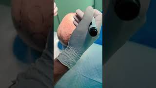 Hair Transplant Dr Rana Irfan MD FACS ABHRS FISHRS Hair Restoration Surgeon [upl. by Lodovico]