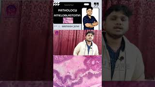 Ameloblastoma  Human Pathology  Full video available in the channel dental [upl. by Itirp973]