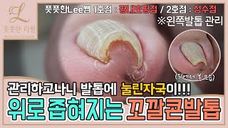 위로 좁혀져있는 꼬깔콘모양의 발톱 관리하고나니 눌린자국이 ingrown toenail  ingrowing nail  Fresh Foot 성수점  평내호평점 [upl. by Cantu]