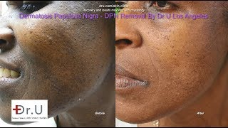 DPN Removal treatment by Erbium YAG Laser  How To Get Rid Of Dermatosis Papulosa Nigra DrKailash [upl. by Ruskin]