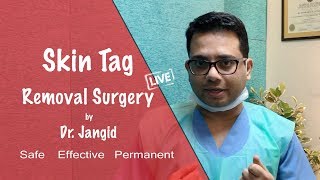 Skin Tag Removal  Skin Tag surgery  Explained Live [upl. by Lordan]