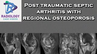 Post traumatic septic arthritis with regional osteoporosis [upl. by Perot]