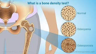 Test Panels for Bone Diseases  Osteoporosis and Fractures [upl. by Souza]