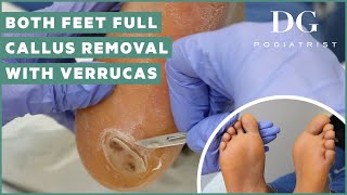 Callus removal from feet both feet and three verruca plantar warts treatment [upl. by Perri]