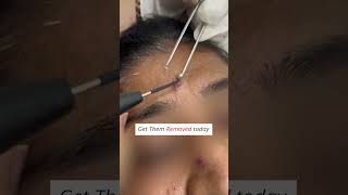 Warts Treatment  Warts Removal Procedure dermatologist skincare wartstreatment skinspecialist [upl. by Maynord164]