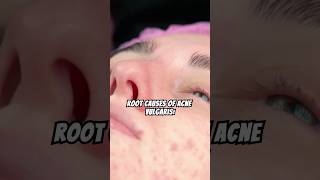 All About ACNE health acne acnetreatment [upl. by Cutlip]