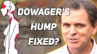 How To Fix Dowagers Hump [upl. by Beaulieu]