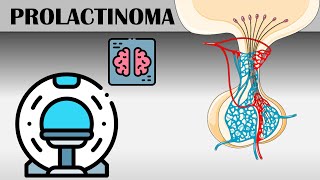 Prolactinoma  Causes Risk Factors Signs amp Symptoms Diagnosis And Treatment [upl. by Goulet]