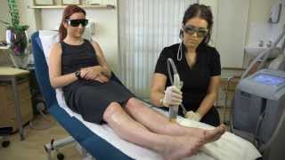 Cutera CoolGlide Laser Hair Removal  Patient Treatment Review  Refresh Laser Clinic Sheffield [upl. by Bac]