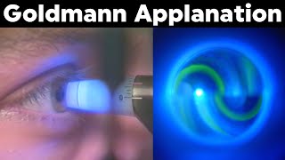 Goldmann Applanation Tonometry Procedure Technique Tutorial [upl. by Atnahc940]