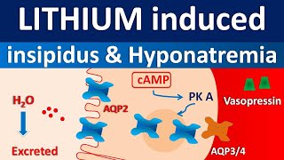 Lithium induced diabetes insipidus and hyponatremia [upl. by Aryhs]