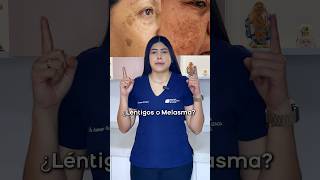 Descubre las diferencias del Lentigo Solar y Melasma👩🏻‍⚕️ melasma manchas manchasenlapiel [upl. by Einaej]