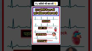 ECG Report stage ecg education gk [upl. by Fernando61]