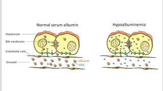 Causes or factors of Hypoalbuminemia [upl. by Doro]