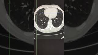 CT assessment  intrapulmonary lymph nodes [upl. by Skylar]