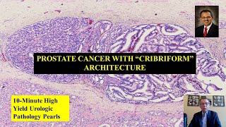 Prostate Cancer with quotCribriform Architecturequot [upl. by Shanta]