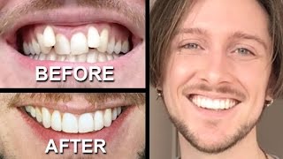 INVISALIGN REVIEW  everything you need to know [upl. by Ahsilahs939]