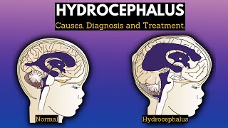 Hydrocephalus Causes Signs and Symptoms Diagnosis and Treatment [upl. by Noteloc832]