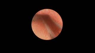 Ureteroscopy and Laser Lithotripsy for Treatment of Ureteral Stones [upl. by Ostraw]