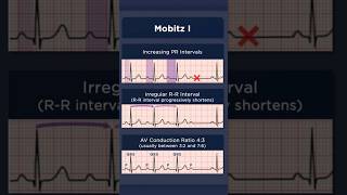 Type I Second Degree Atrioventricular Block ECG AV conduction ratio [upl. by Armat30]