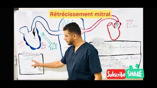 Rétrécissement mitral [upl. by Lewls]